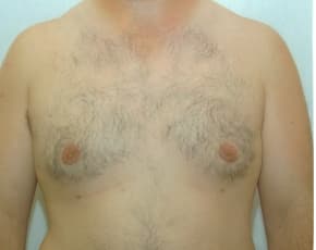 Male Breast Reduction Before & After Patient #861