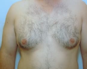 Male Breast Reduction Before & After Patient #861