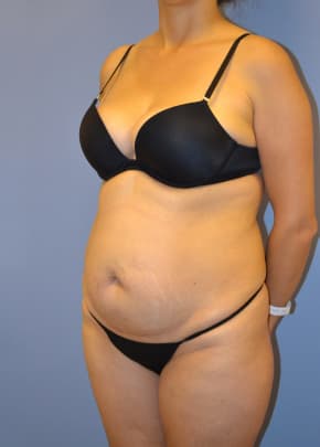 Tummy Tuck Before & After Patient #1100