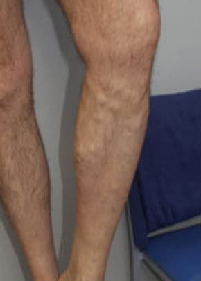 Spider Vein Removal Before & After Patient #3139