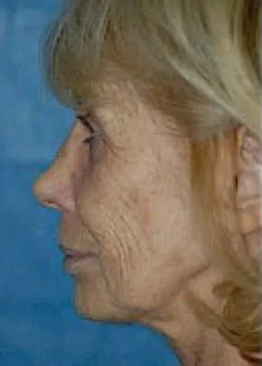 Mini Facelift Before & After Patient #3447