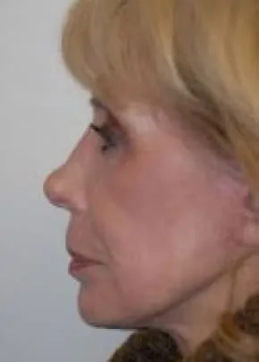 Mini Facelift Before & After Patient #3447