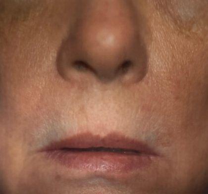 Lip Lift Before & After Patient #3657