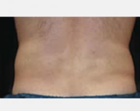 CoolSculpting Before & After Patient #2148