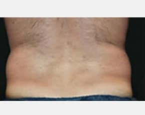 CoolSculpting Before & After Patient #2148