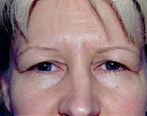 Eyelid Surgery Browlift Before & After Patient #1844