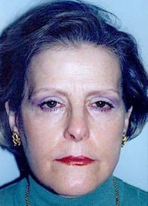 Eyelid Surgery Browlift Before & After Patient #1842