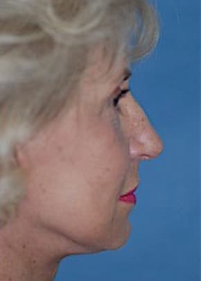 Facelift and Necklift Before & After Patient #1759