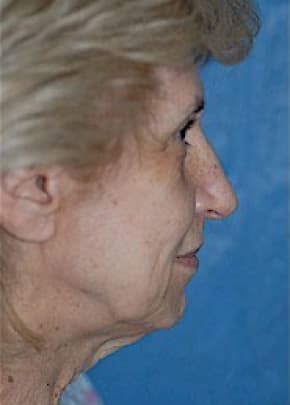 Facelift and Necklift Before & After Patient #1759