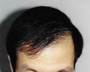 Hair Transplant Before & After Patient #2053