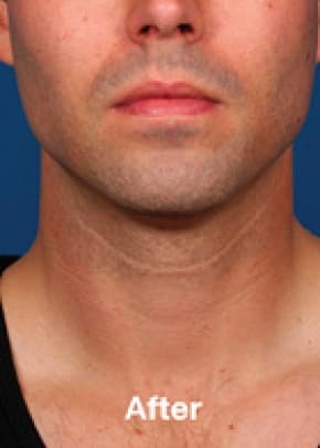 Kybella Before & After Patient #2246