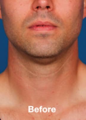 Kybella Before & After Patient #2246