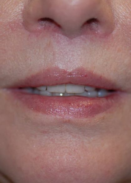 Lip Enhancement Before & After Patient #2006