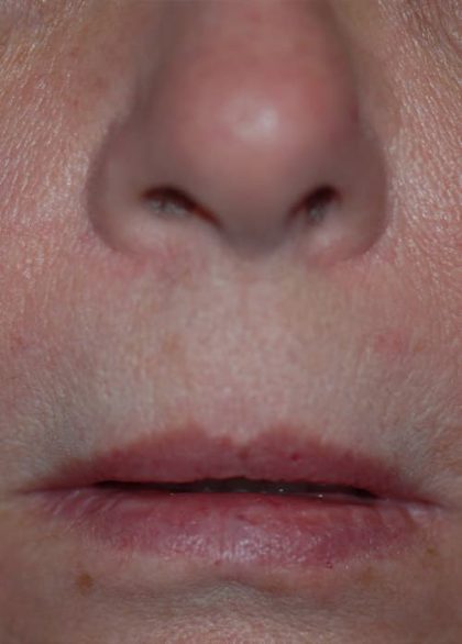 Lip Enhancement Before & After Patient #2006