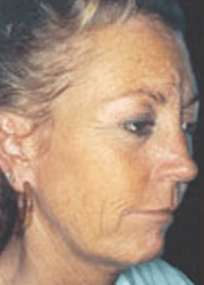 Skin Peels Before & After Patient #2248