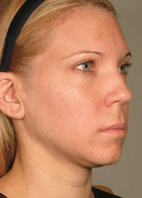 Ultherapy Before & After Patient #2194