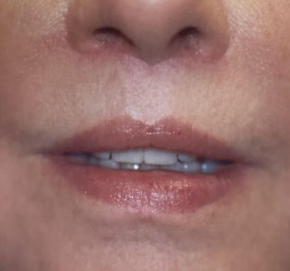 Lip Lift Before & After Patient #3657